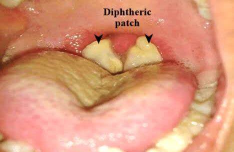 Diphtheria